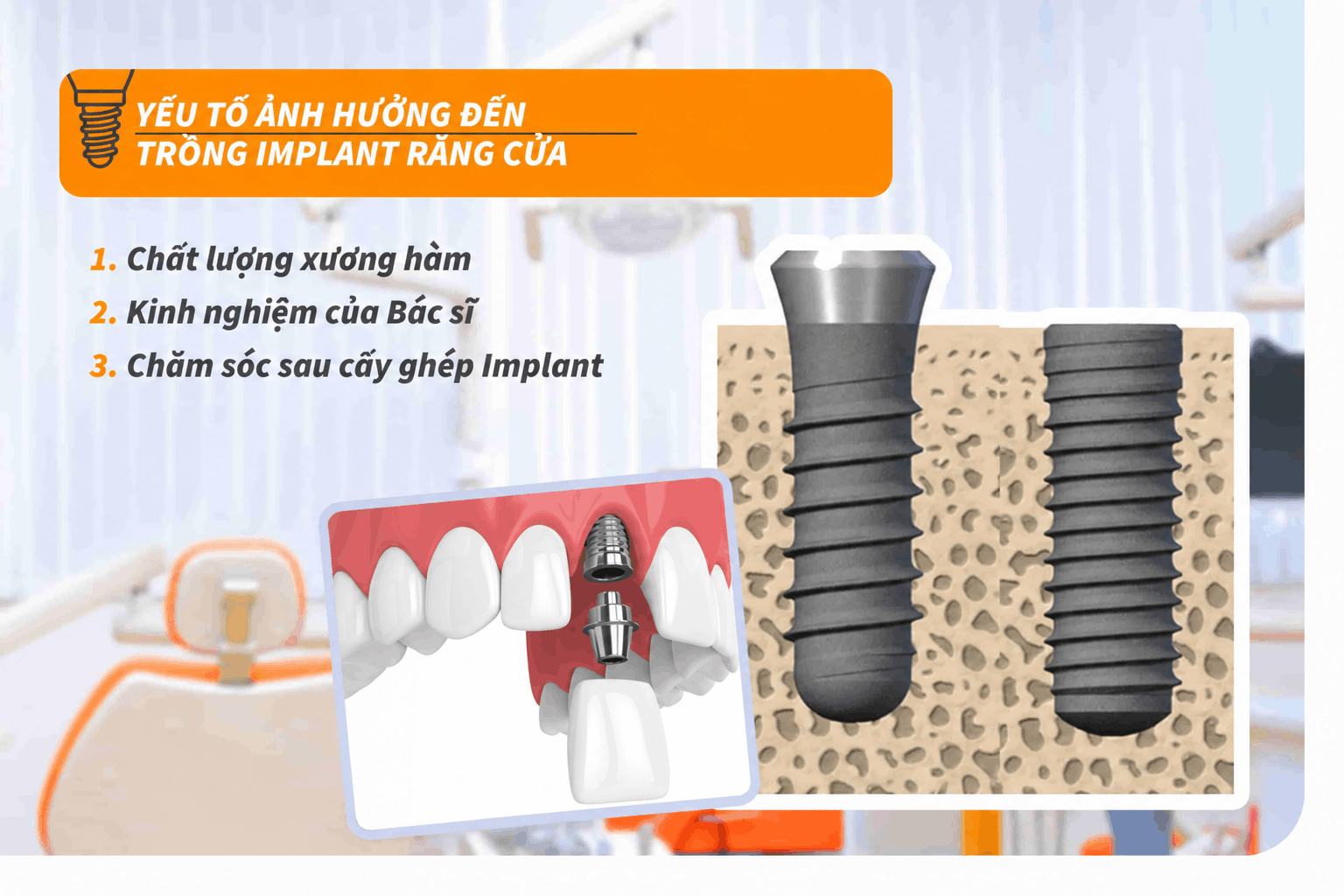 Yếu tố ảnh hưởng đến trồng Implant răng cửa