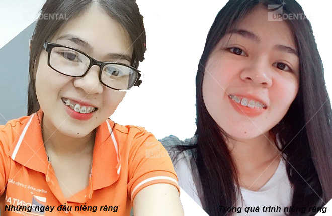 anh nieng rang lech lac