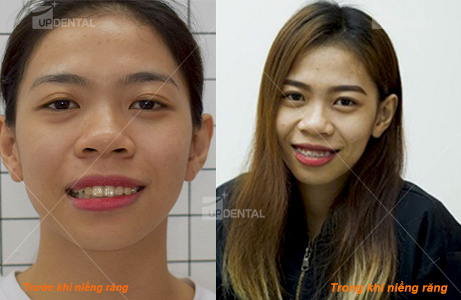 hinh anh truoc va sau khi nieng rang
