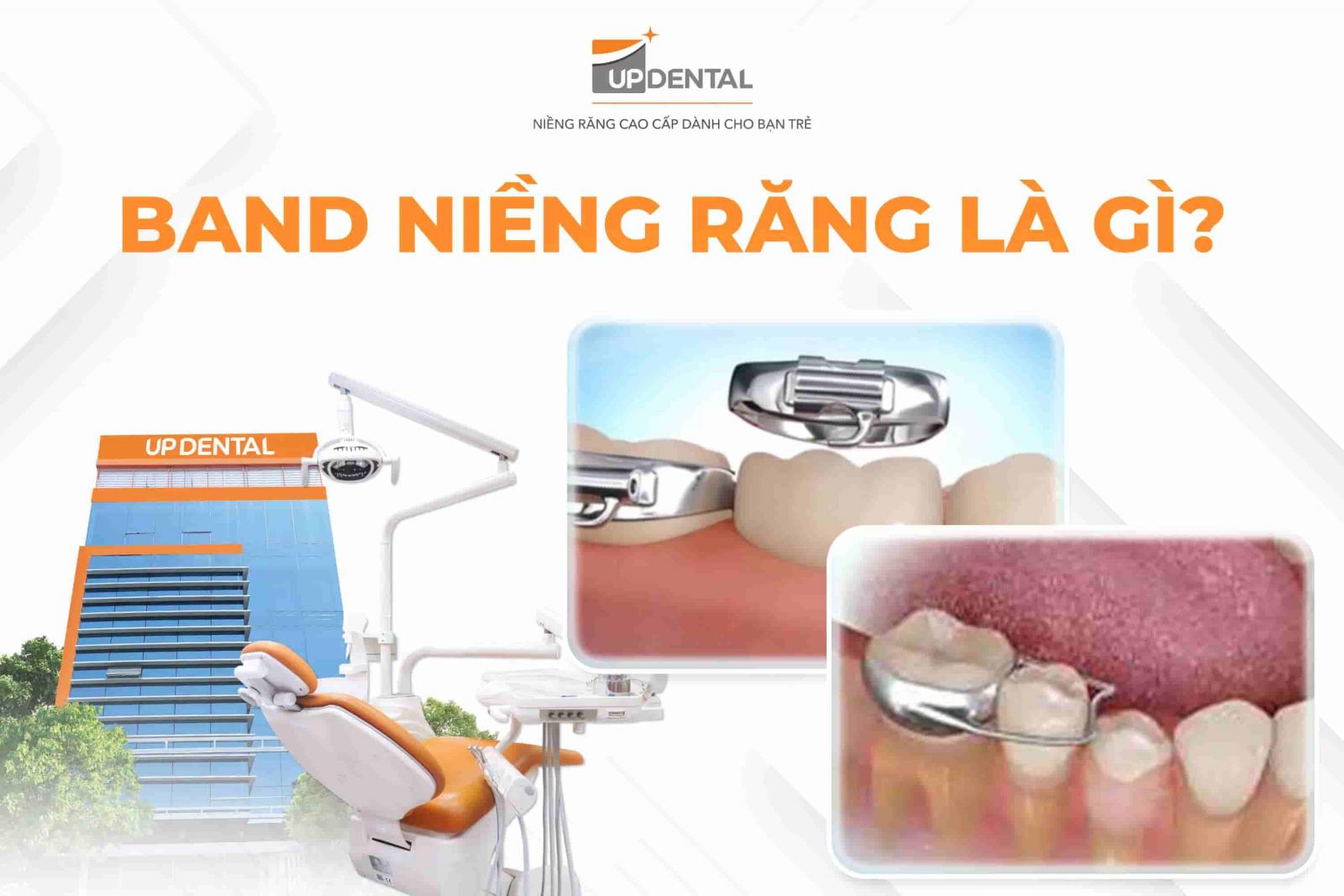 Band niềng răng là gì?