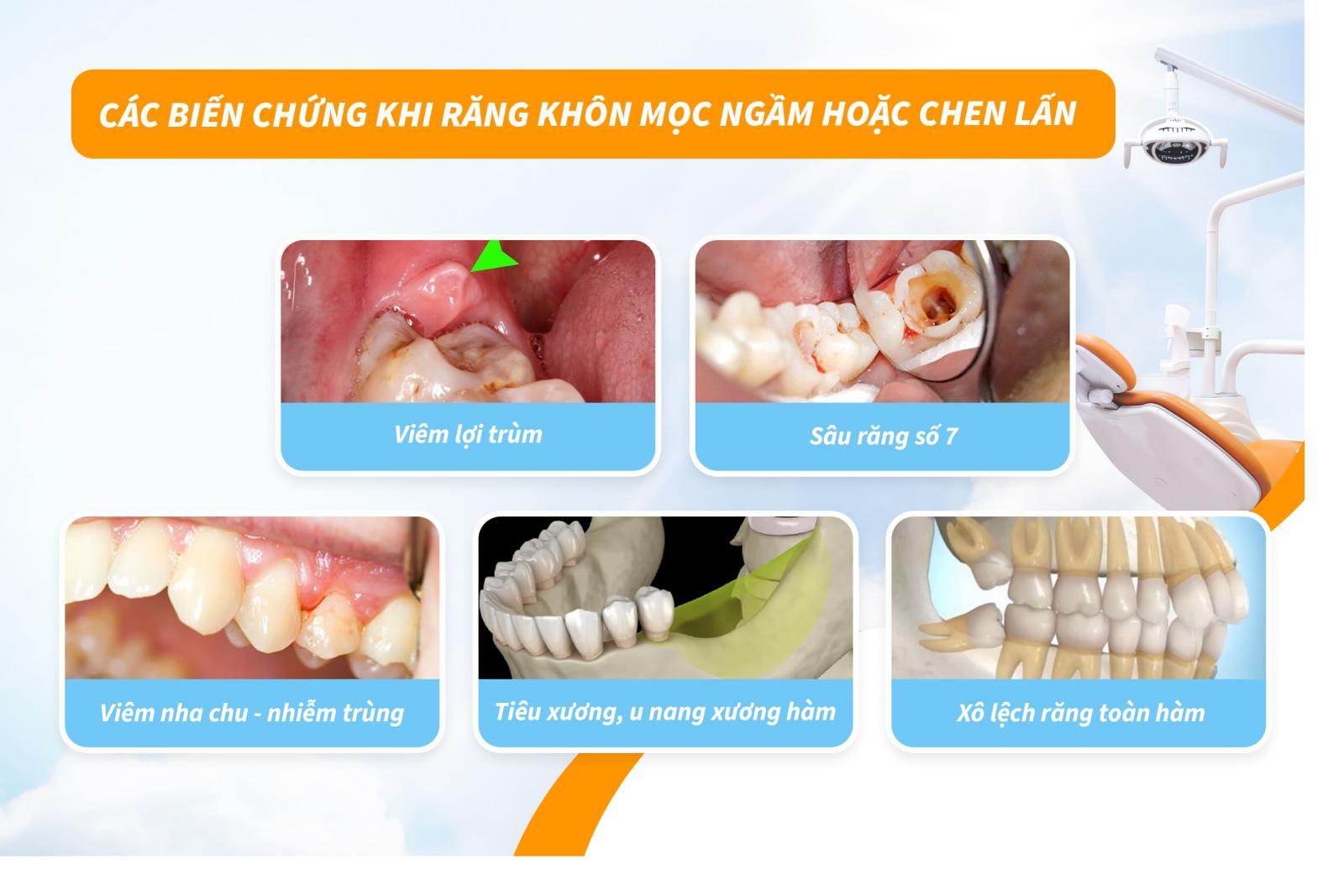 Các biến chứng khi răng khôn mọc ngầm hoặc chen lấn