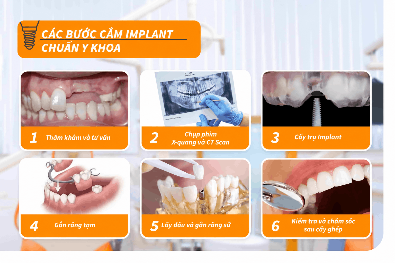 Các bước cắm Implant chuẩn Y khoa
