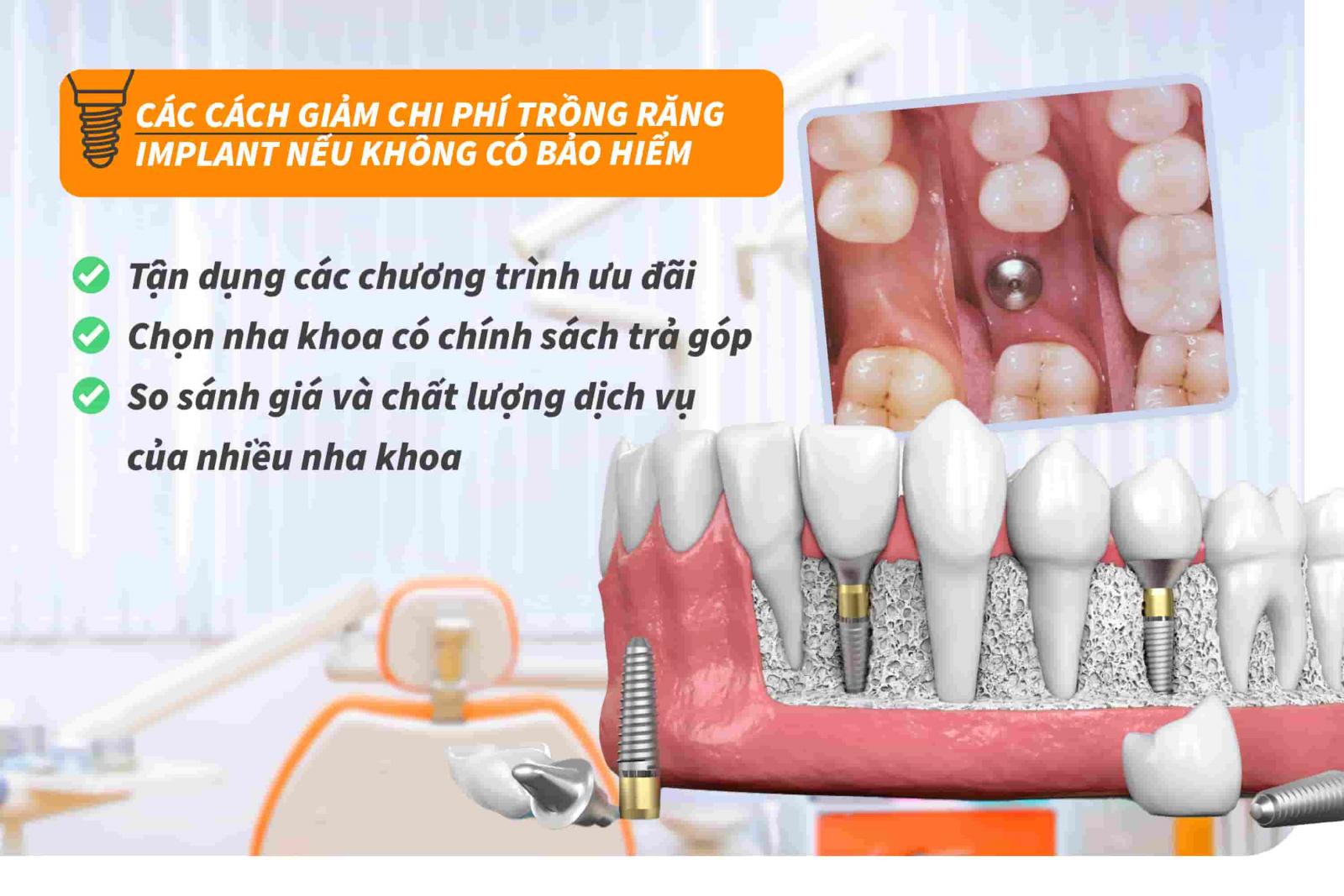 Các cách giảm chi phí trồng răng Implant nếu không có bảo hiểm