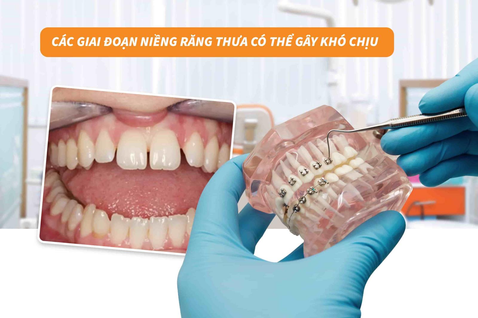 Các giai đoạn niềng răng thưa có thể gây khó chịu 