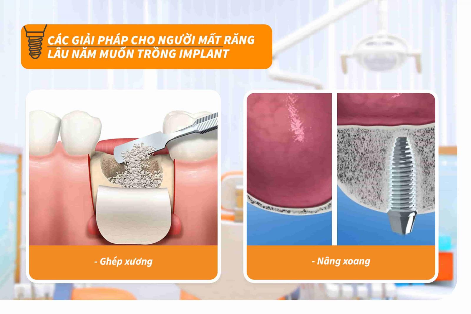 Các giải pháp cho người mất răng lâu năm muốn trồng Implant
