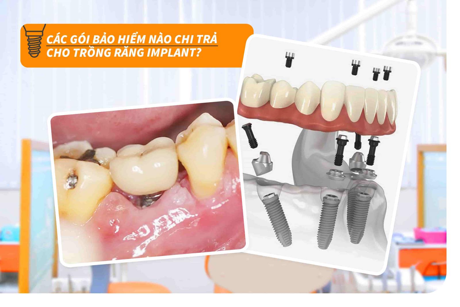 Các gói bảo hiểm nào chi trả cho trồng răng Implant?