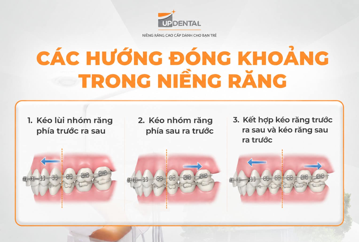 Các hướng đóng khoảng trong niềng răng