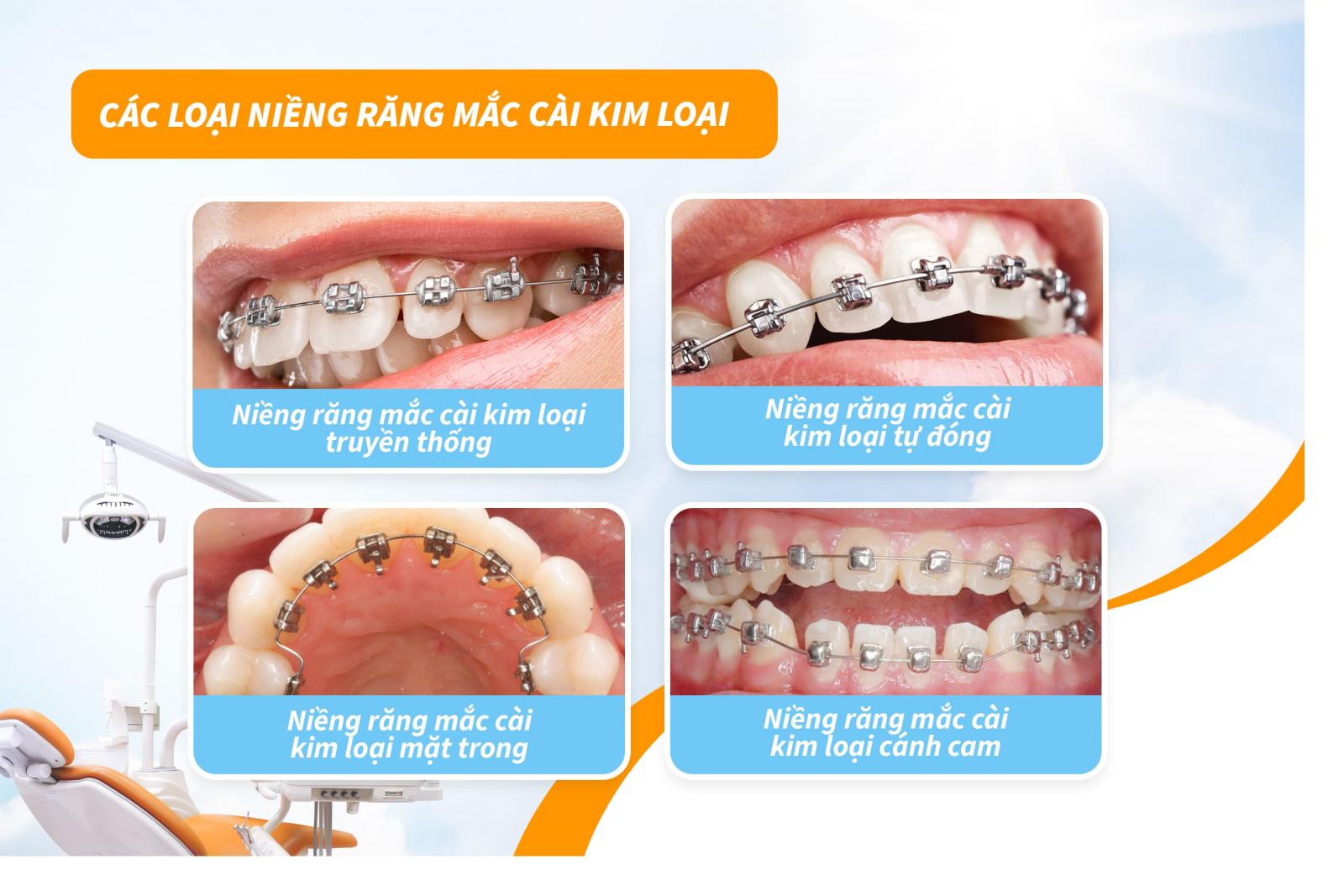 Các loại niềng răng mắc cài kim loại