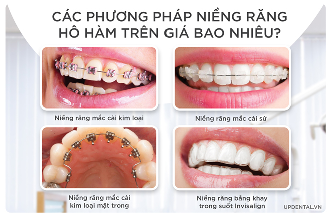 các phương pháp niềng răng hô hàm trên