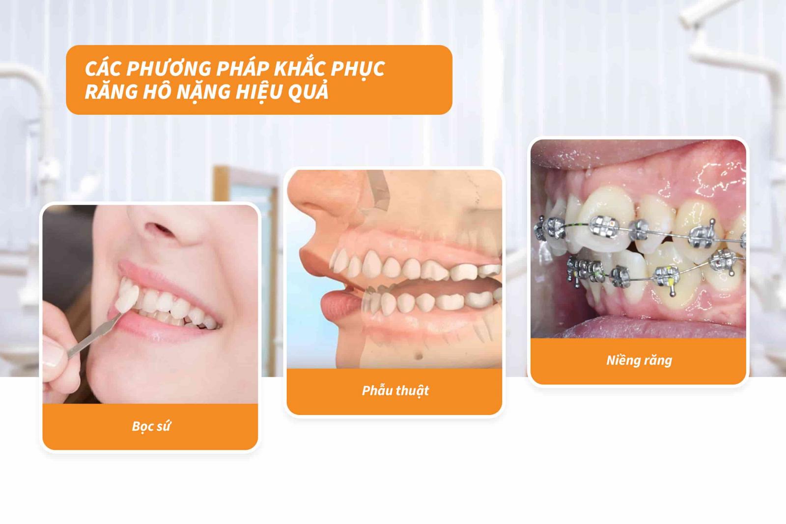 Các phương pháp khắc phục răng hô nặng hiệu quả