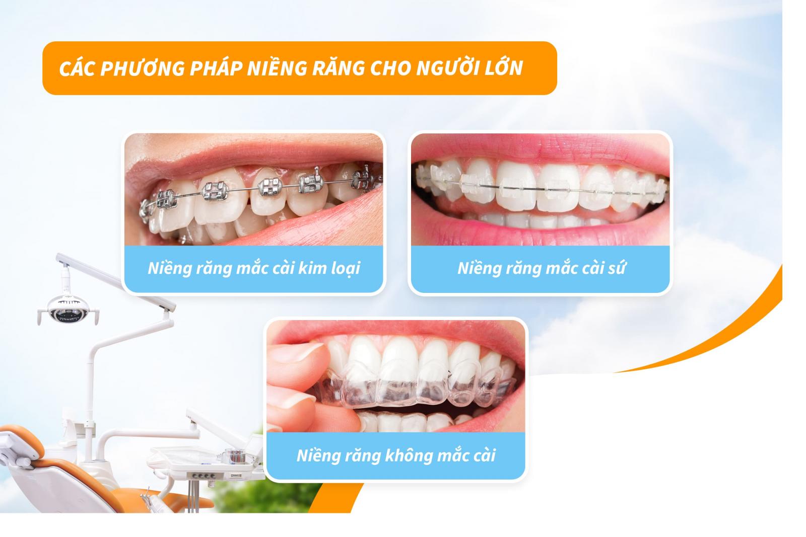 Các phương pháp niềng răng cho người lớn