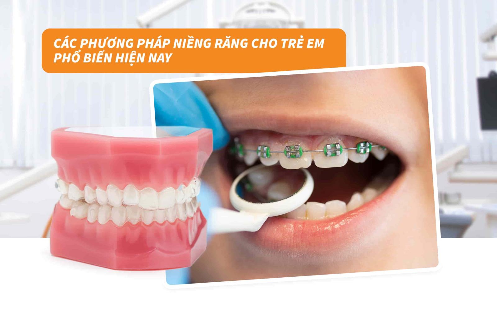 Phương pháp niềng răng cho trẻ em hiệu quả