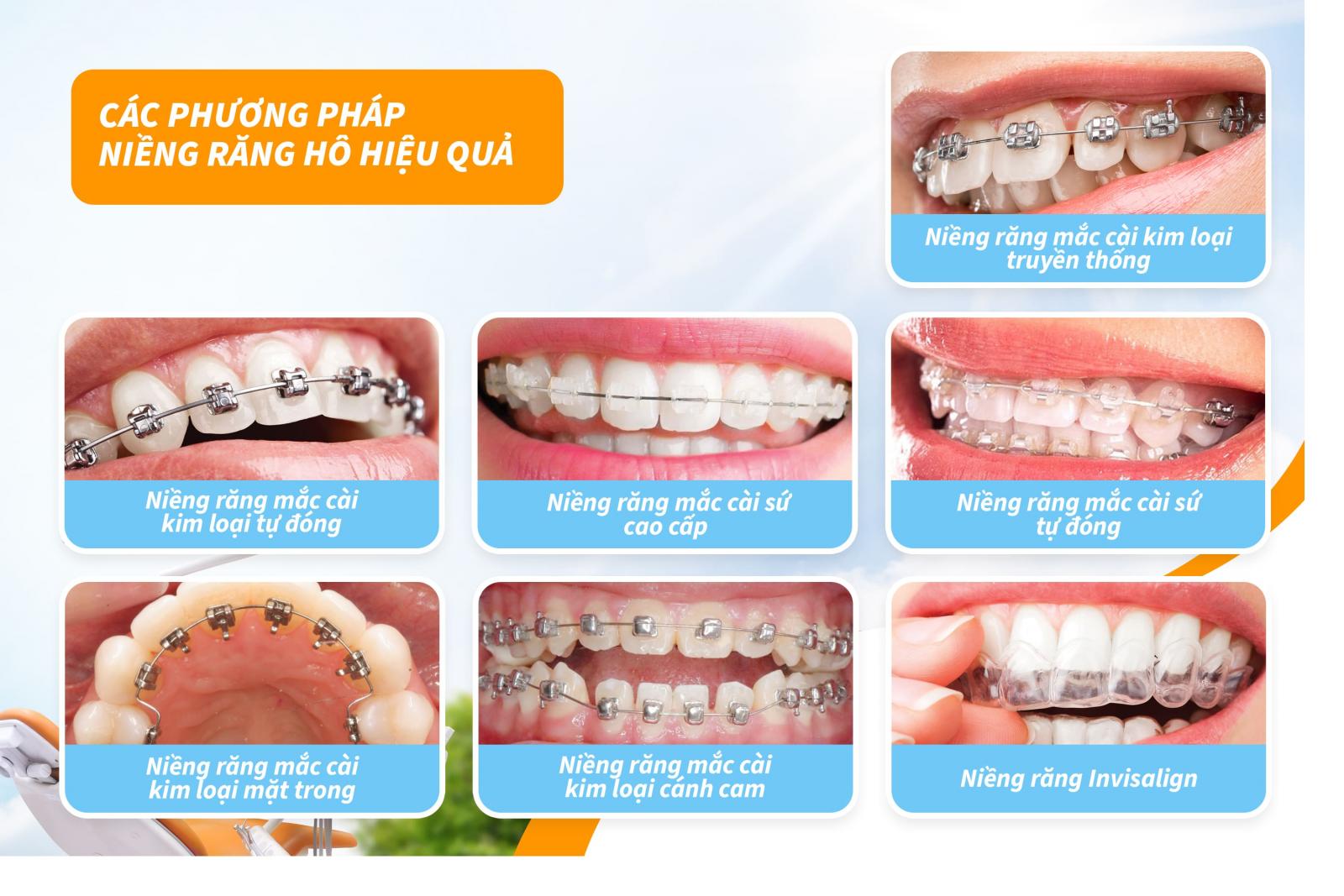 Các phương pháp niềng răng hô hiệu quả