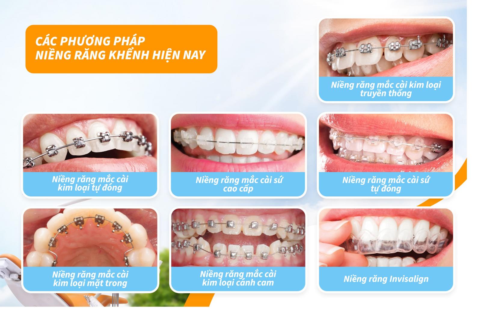 Các phương pháp niềng răng khểnh và chi phí niềng răng khểnh hiện nay