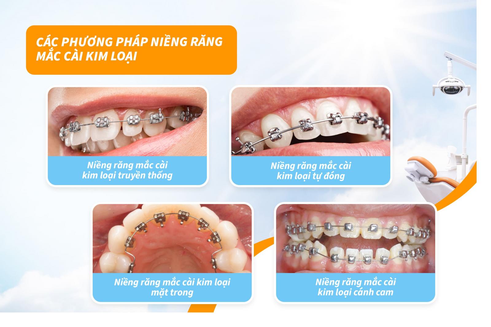 Giá các phương pháp niềng răng mắc cài kim loại