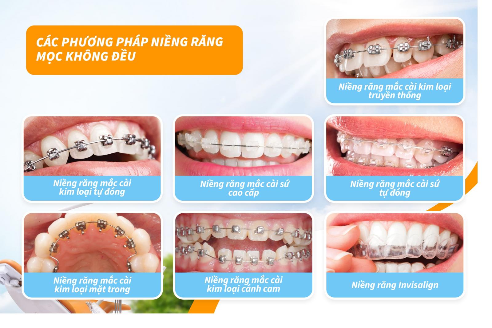 Các phương pháp niềng răng mọc không đều