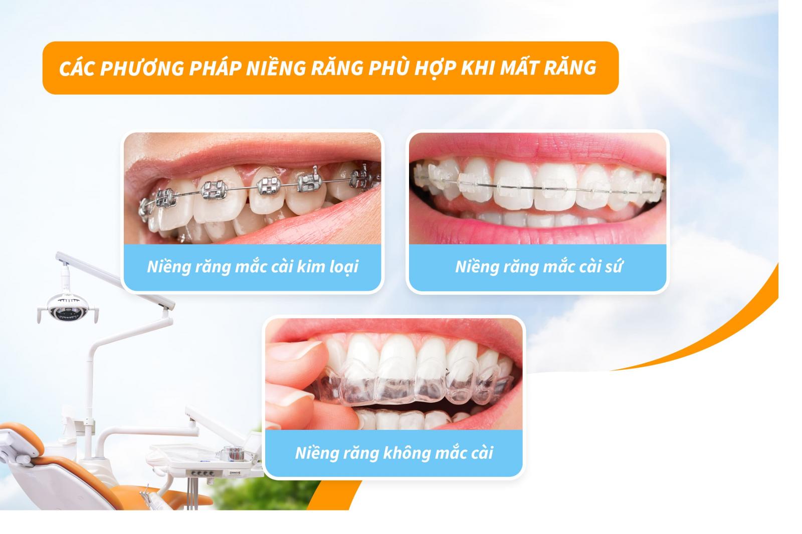Các phương pháp niềng răng phù hợp khi mất răng