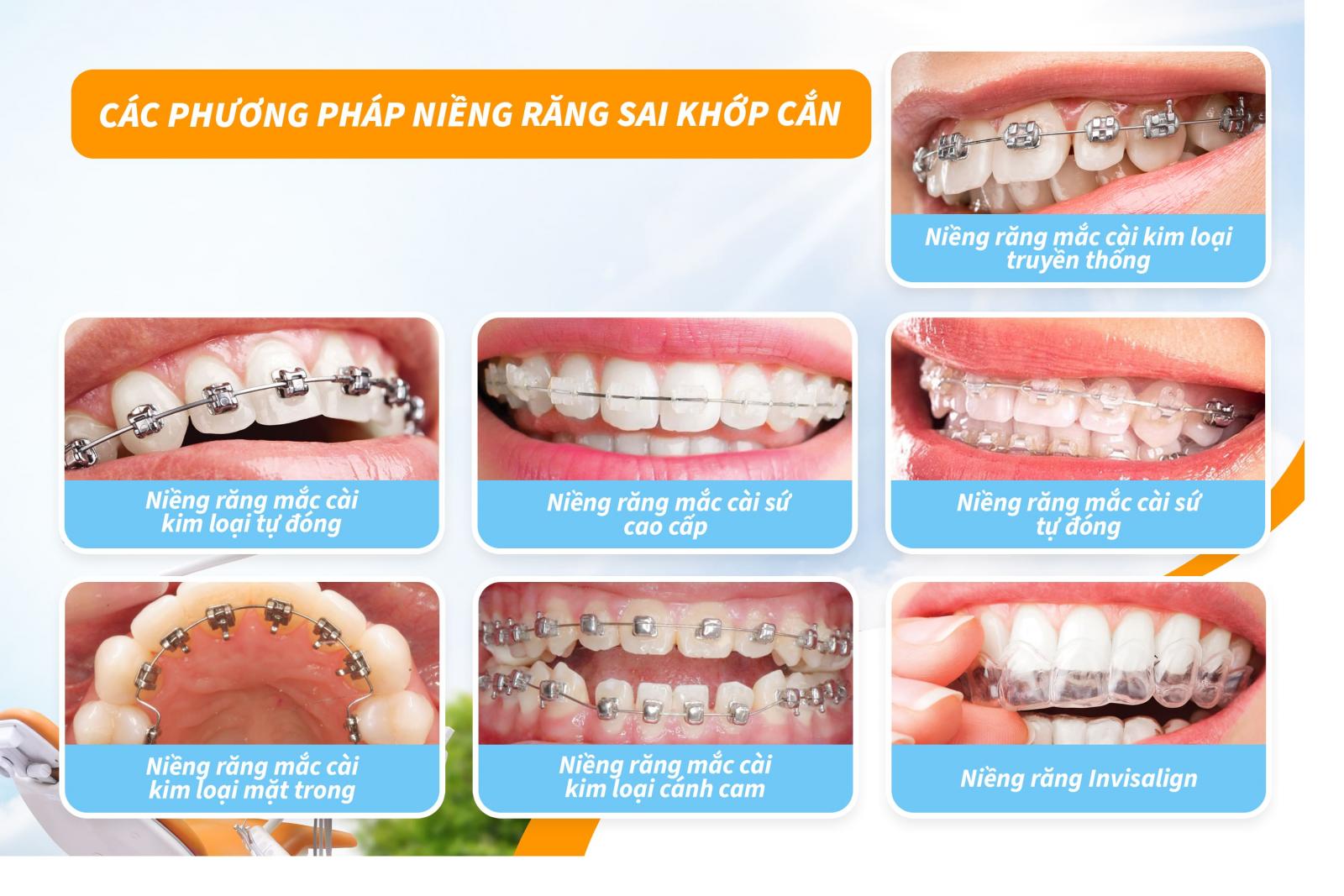 Các phương pháp niềng răng sai khớp cắn