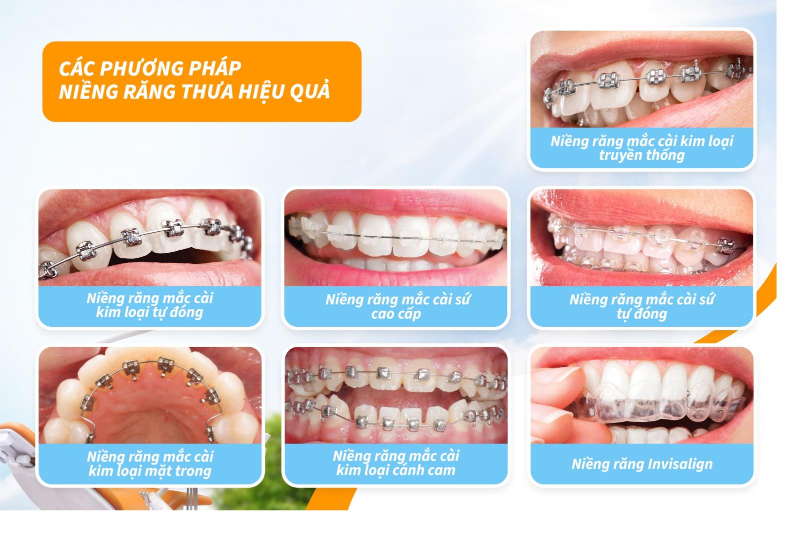 Các phương pháp niềng răng thưa hiệu quả