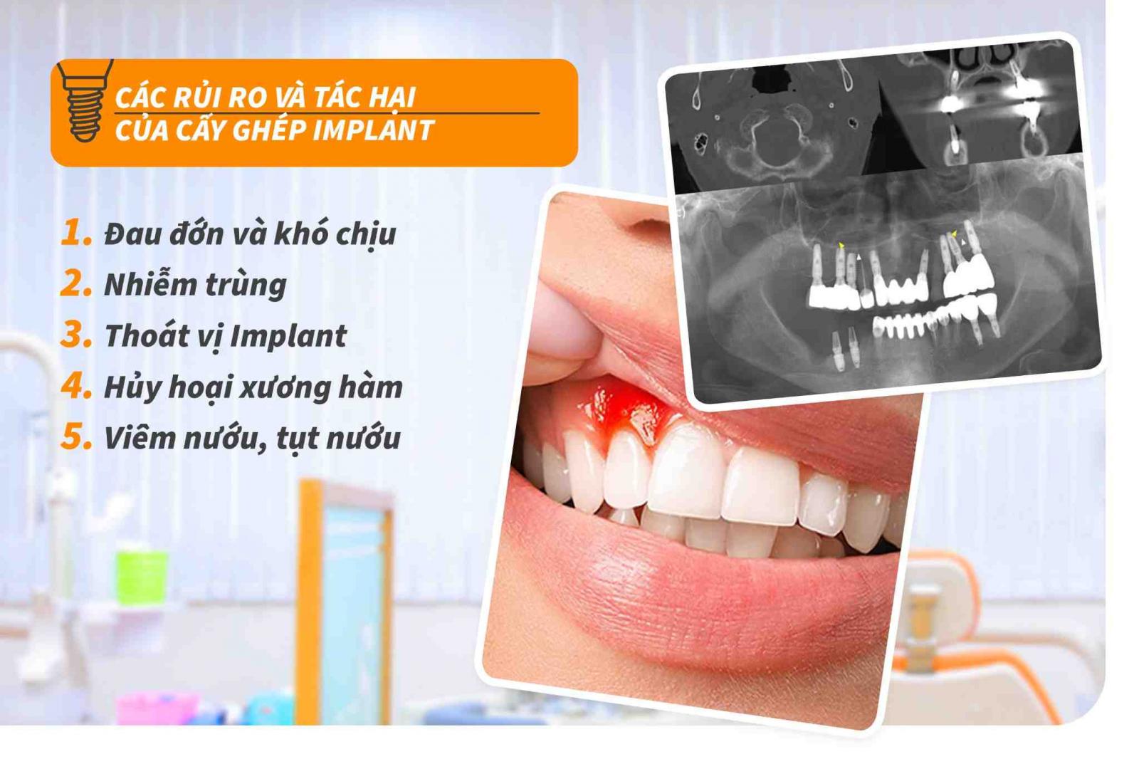 Các rủi ro và tác hại của cấy ghép Implant 
