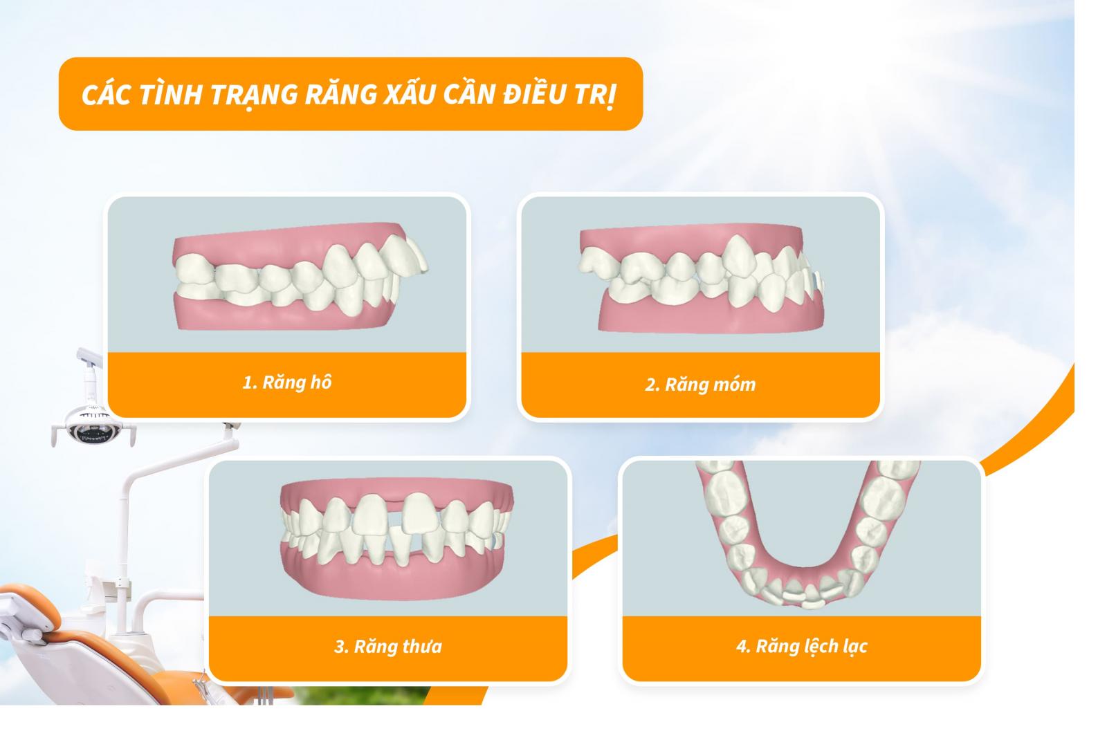 Các tình trạng răng xấu cần điều trị