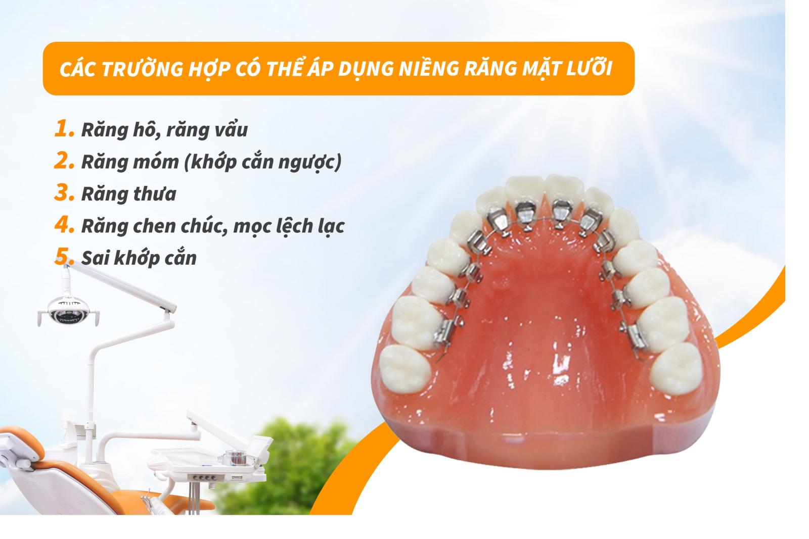 Các trường hợp có thể áp dụng niềng răng mặt lưỡi