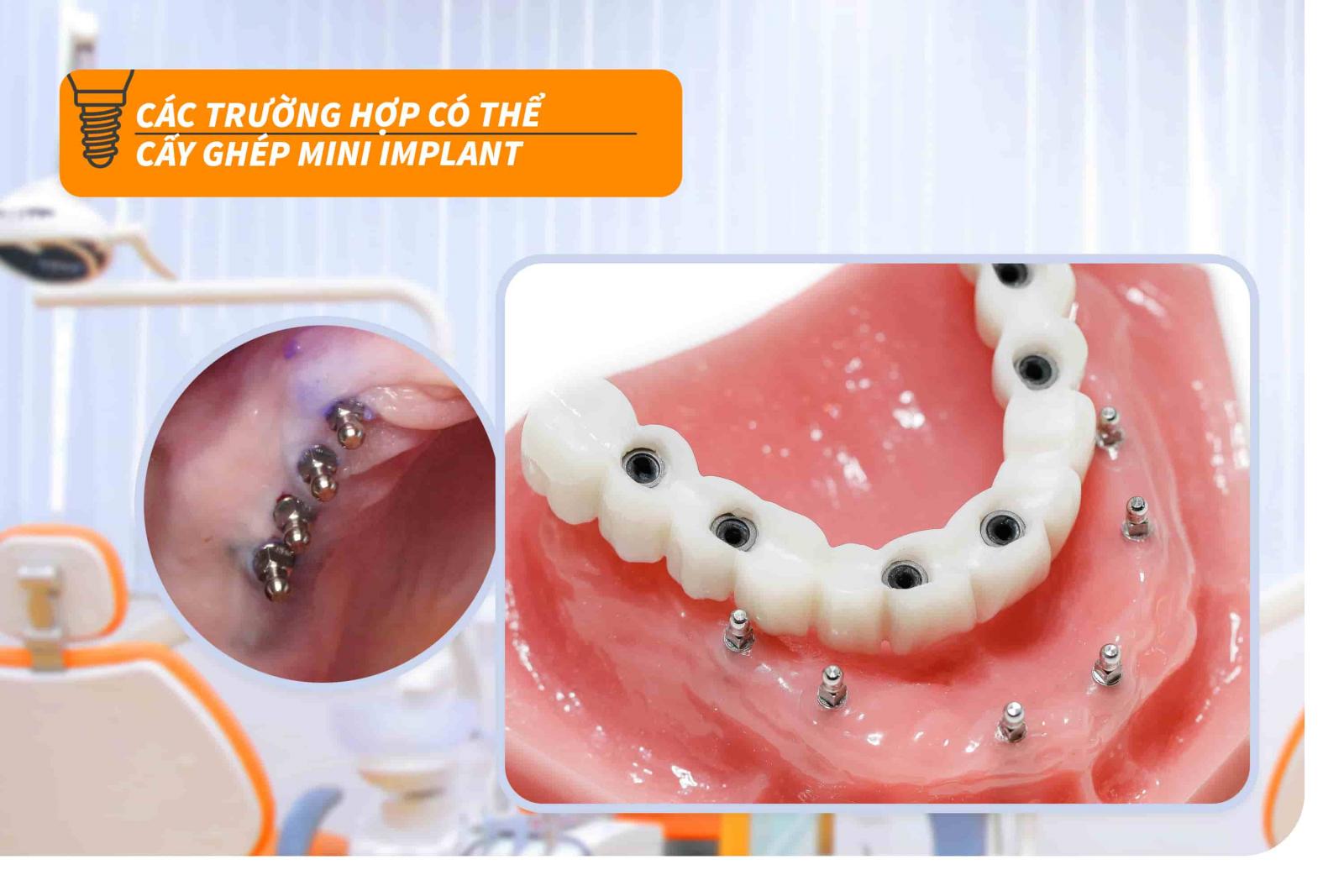 Các trường hợp có thể cấy ghép Mini Implant
