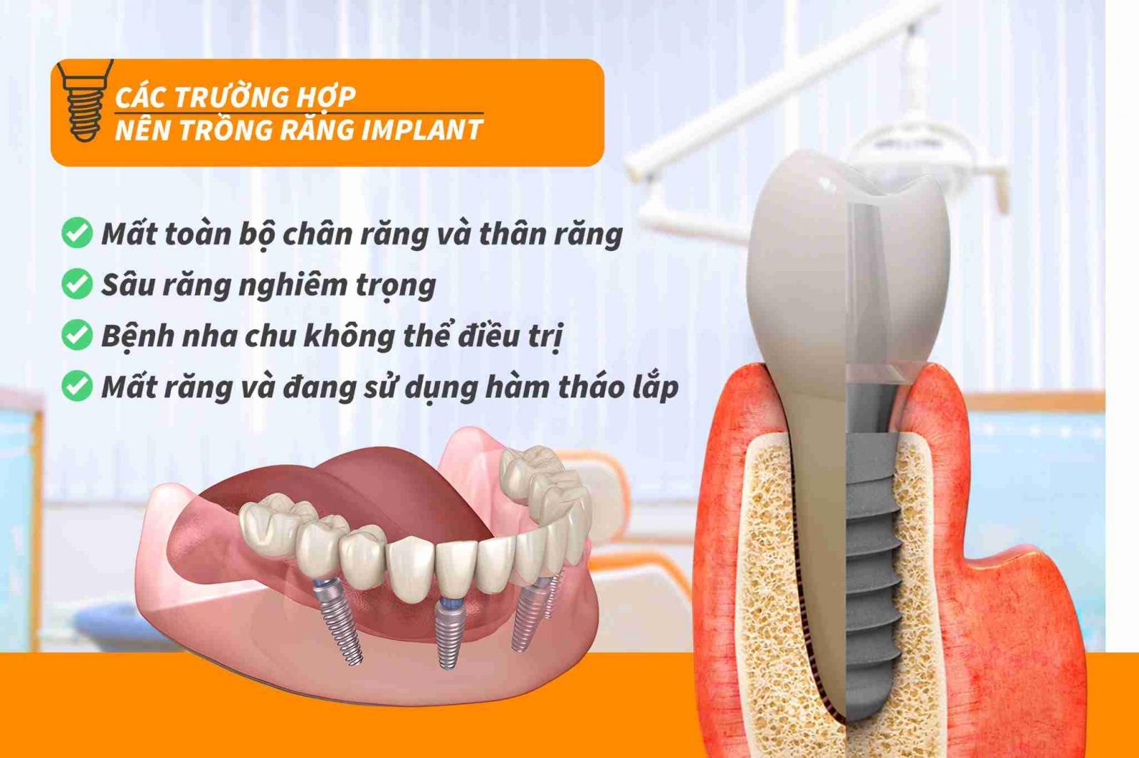 Các trường hợp nên trồng răng Implant
