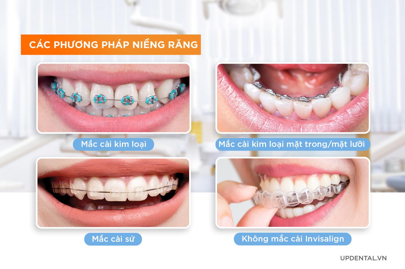 các phương pháp niềng răng phổ biến hiện nay