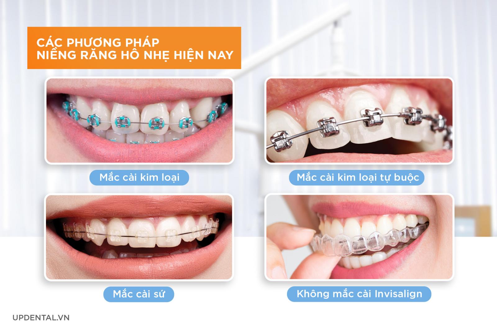 Các phương pháp niềng răng hô nhẹ