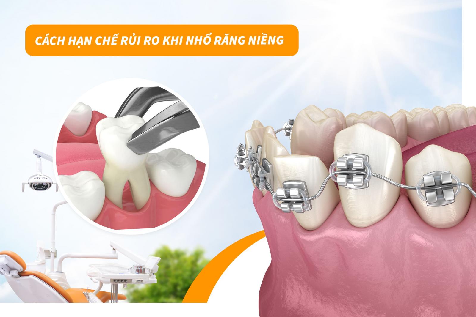 Cách hạn chế rủi ro khi nhổ răng niềng
