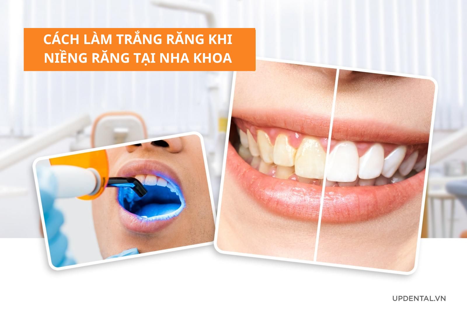 Cách làm trắng răng khi niềng răng tại Nha khoa