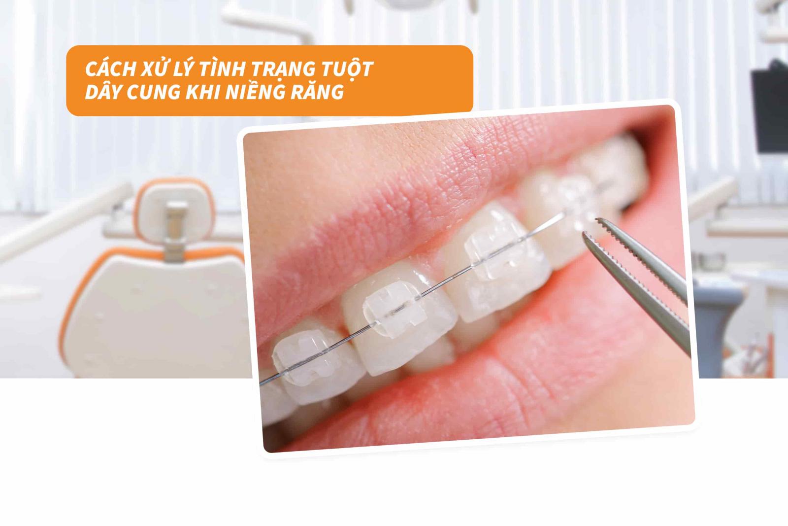 Cách xử lý tình trạng tuột dây cung khi niềng răng