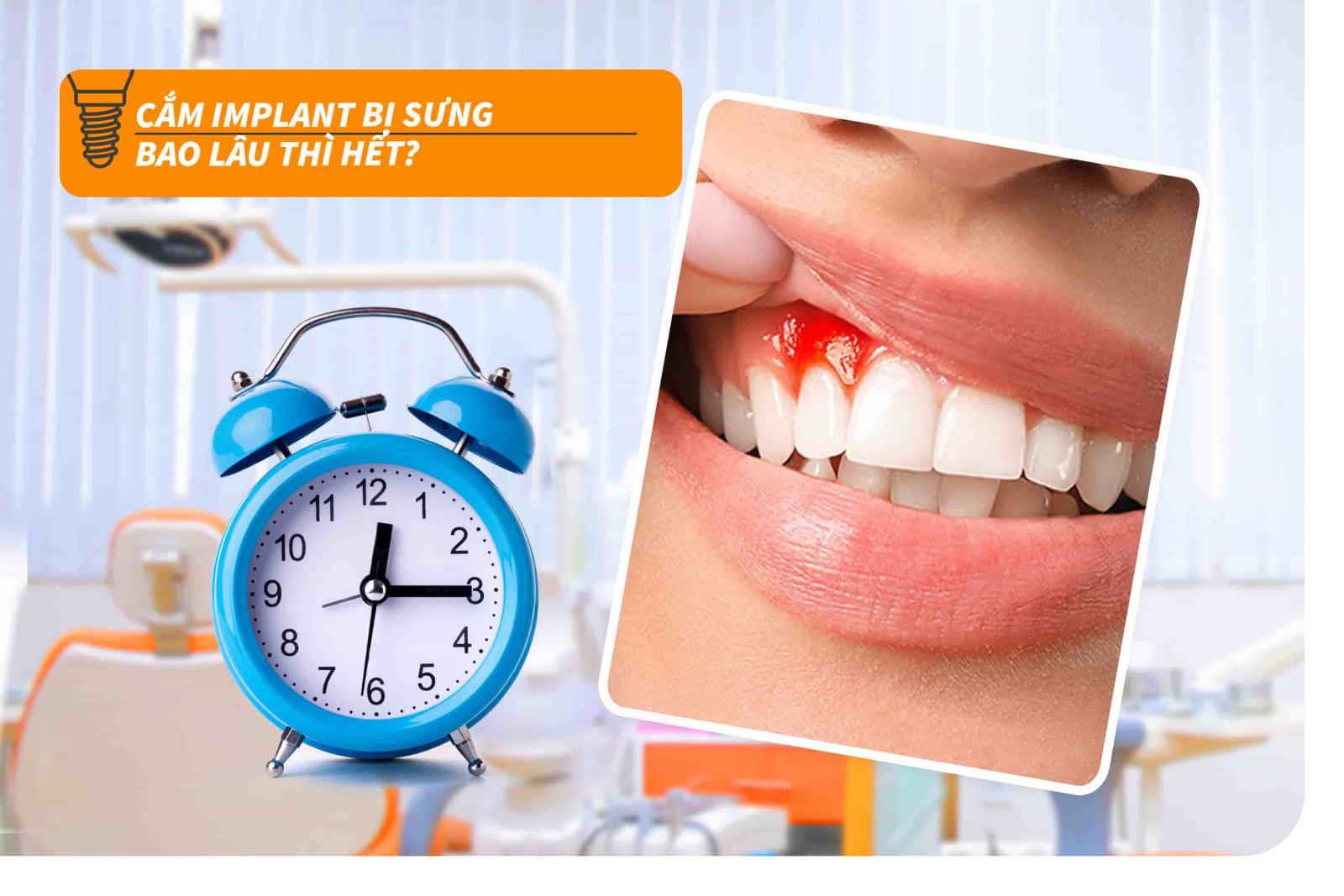Cắm implant bị sưng bao lâu thì hết?
