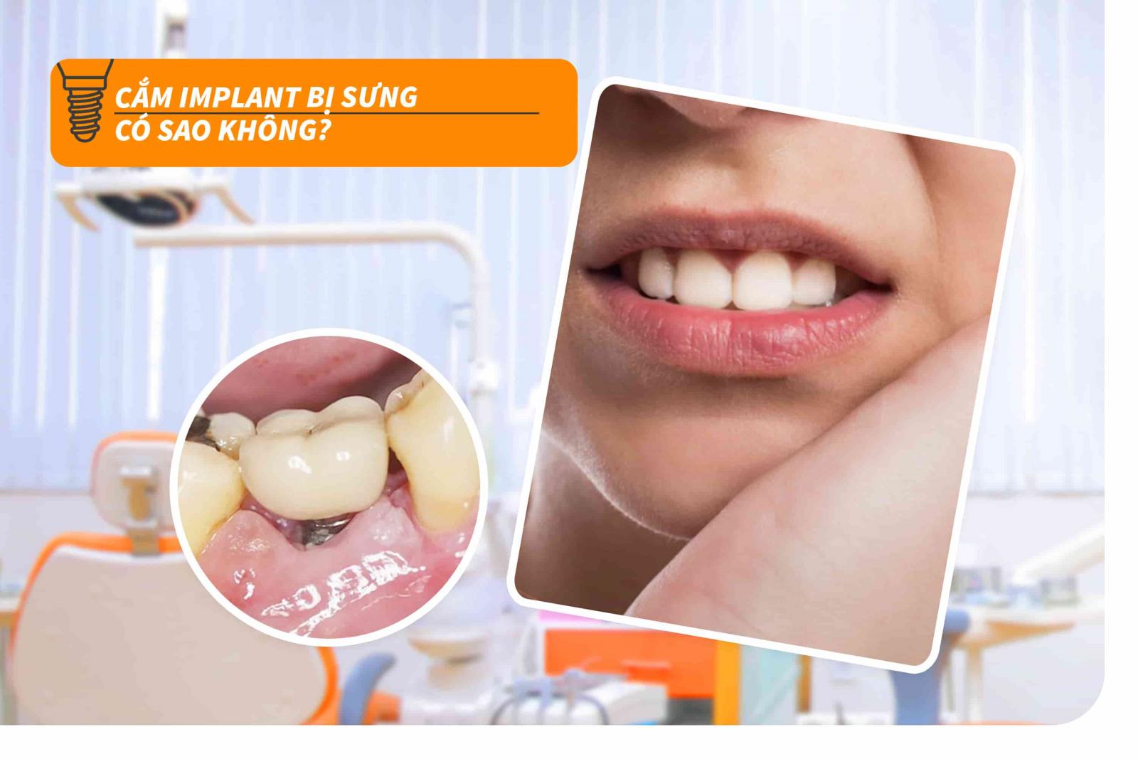 Cắm implant bị sưng có sao không?