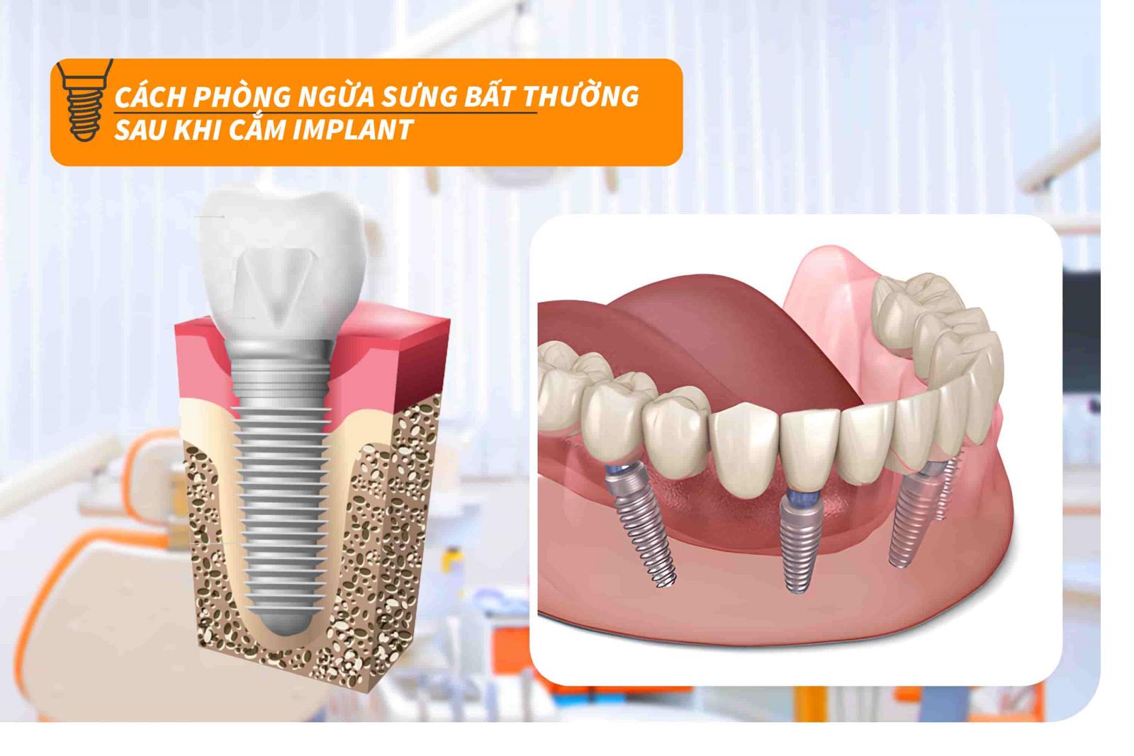 Cách phòng ngừa sưng bất thường sau khi cắm Implant