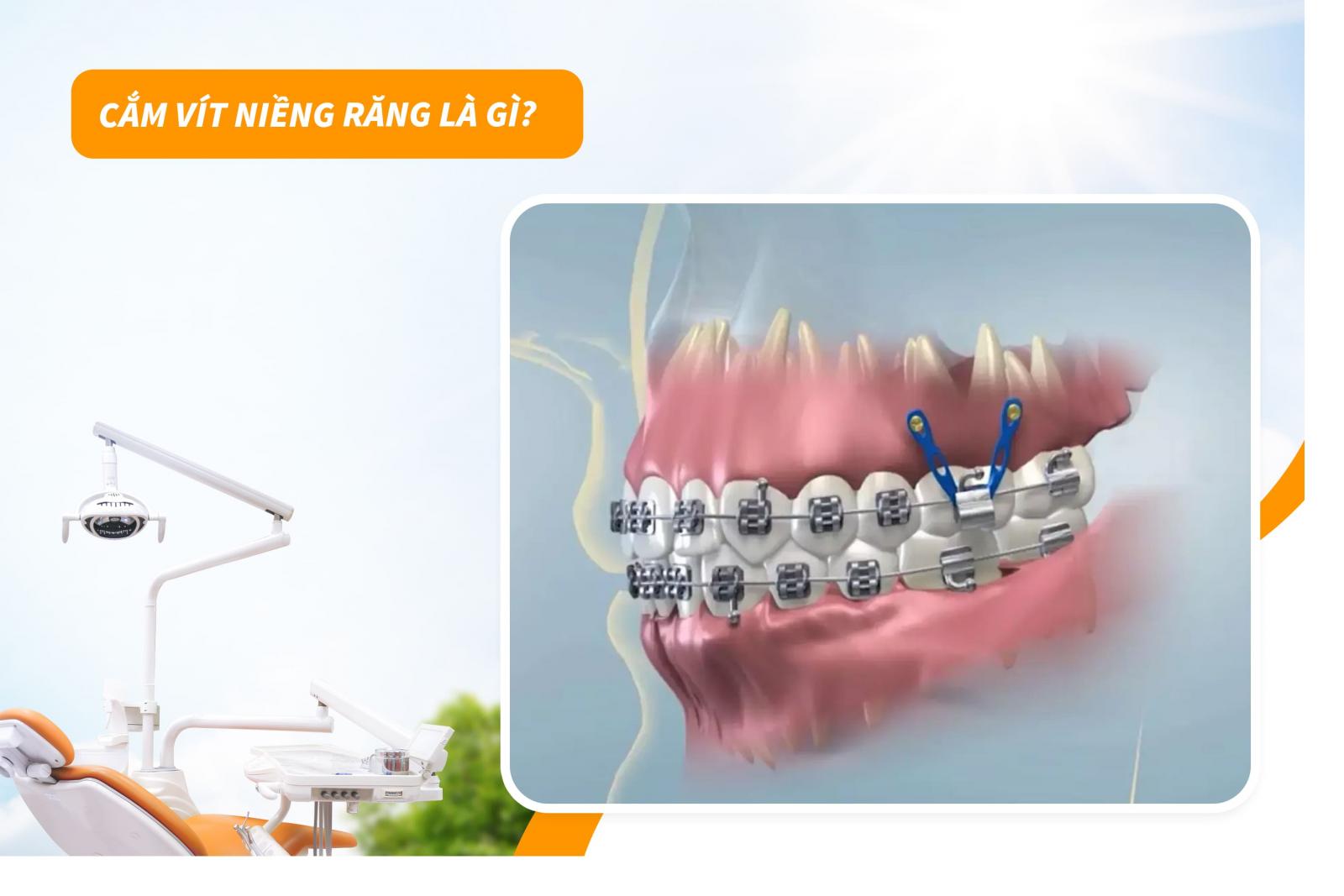 Cắm vít niềng răng là gì?