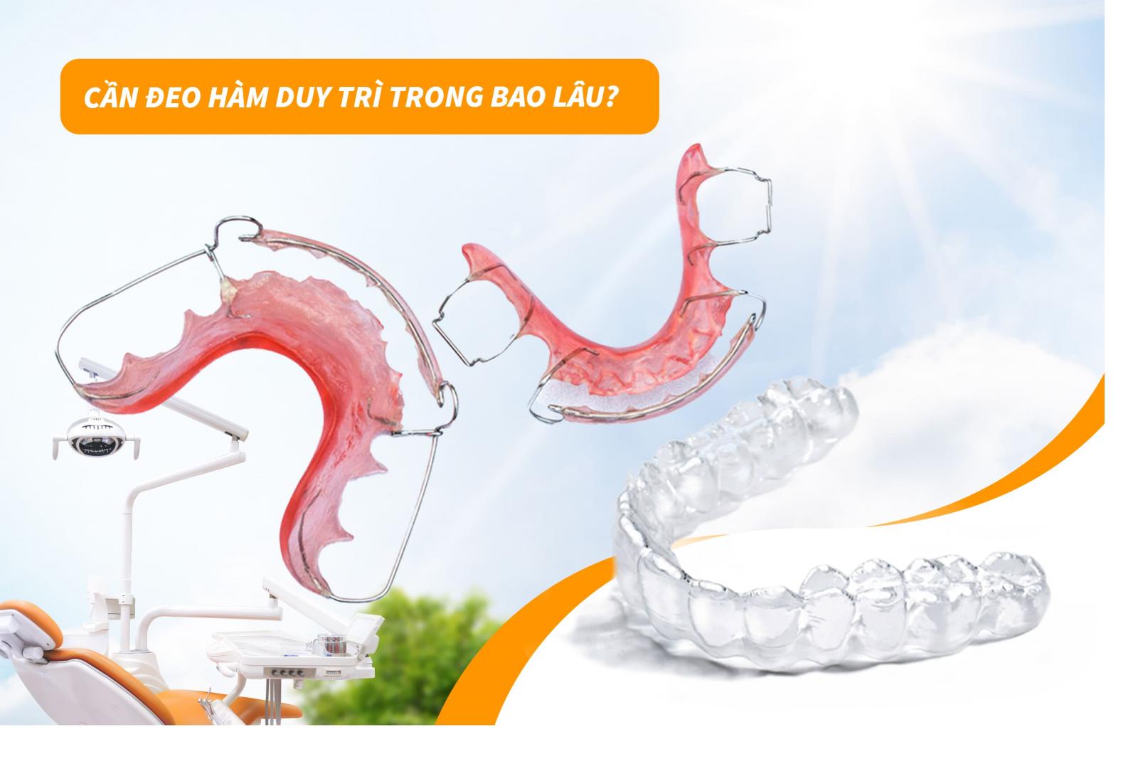 Cần đeo hàm duy trì trong bao lâu?