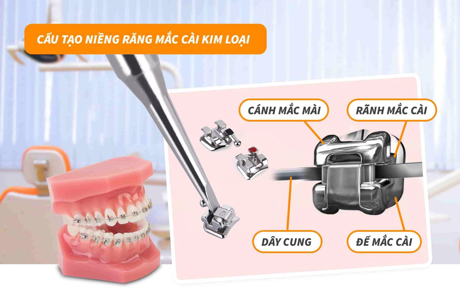 Cấu tạo niềng răng mắc cài kim loại