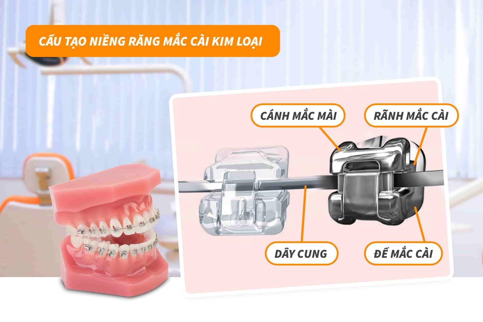 Cấu tạo niềng răng mắc cài kim loại