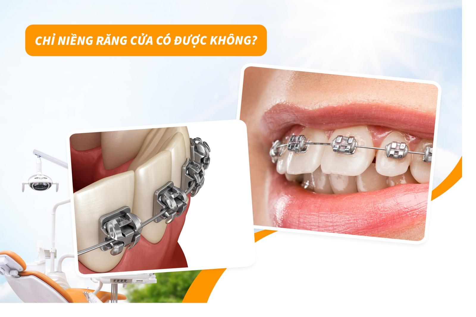 Chỉ niềng răng cửa có được không?