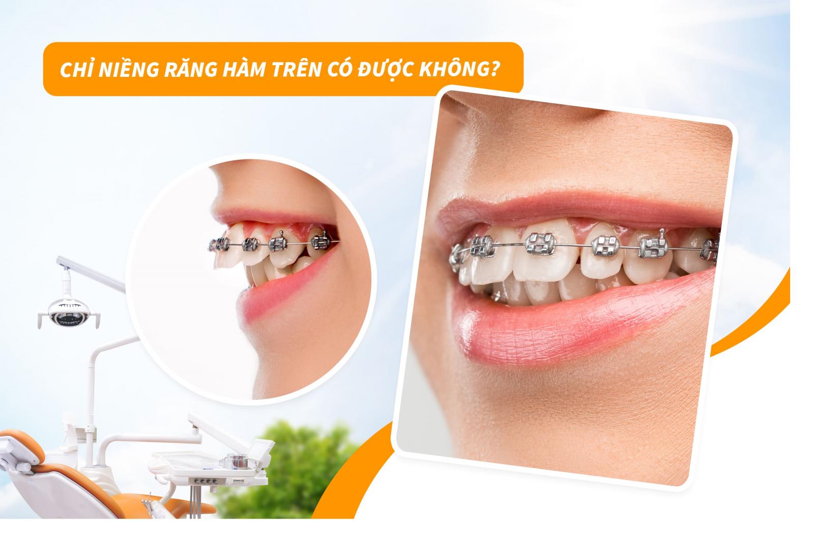 Chỉ niềng răng hàm trên có được không?