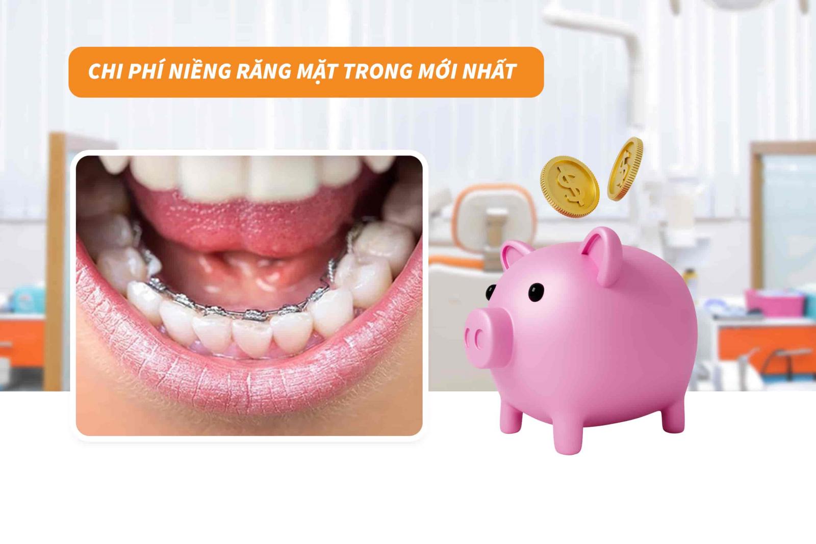Giá niềng răng mặt trong mới nhất tại Up Dental