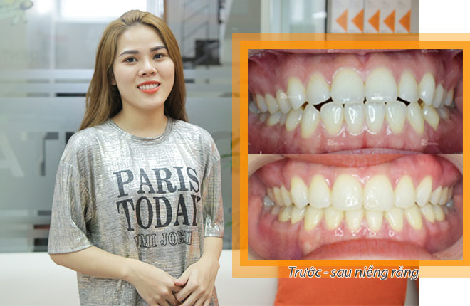 review niềng răng Up Dental Yến Nhi