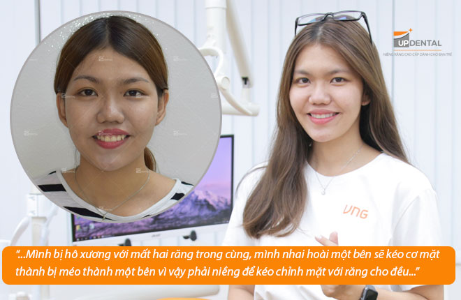 review niềng răng Up Dental Lan Thanh