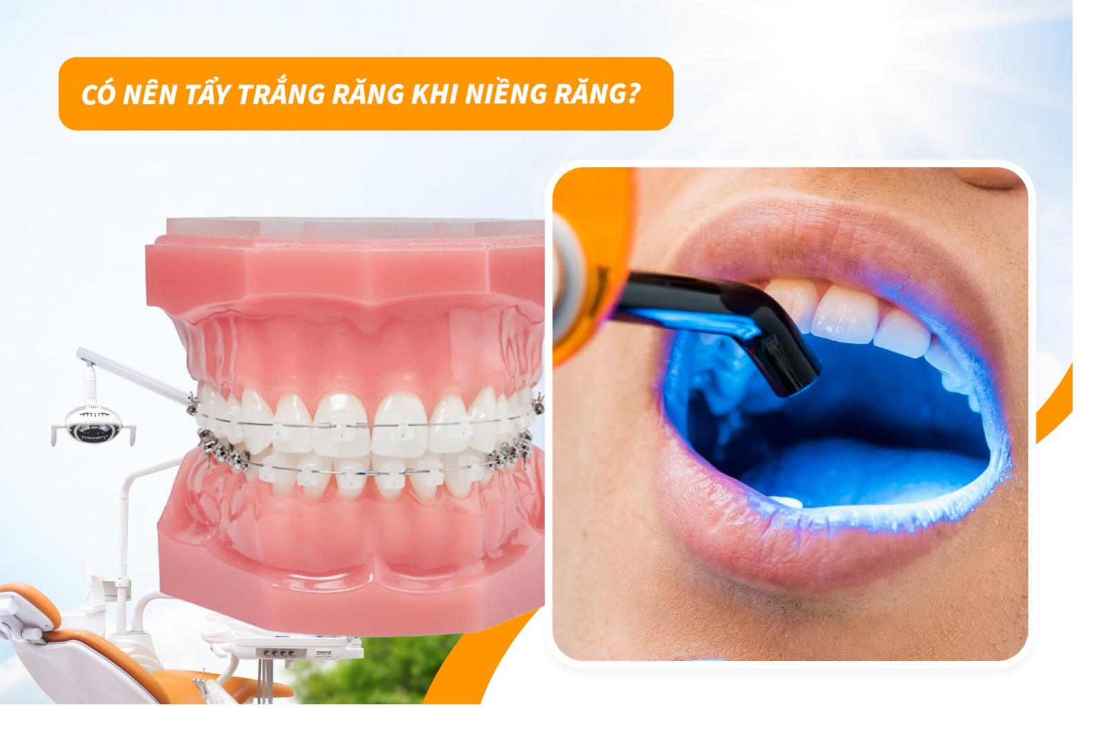 Có nên tẩy trắng răng khi niềng răng?