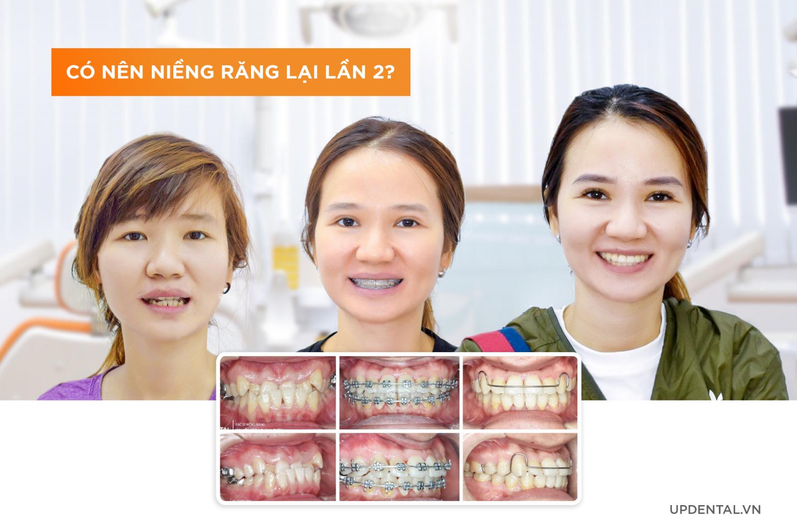 Có nên niềng răng lại lần 2