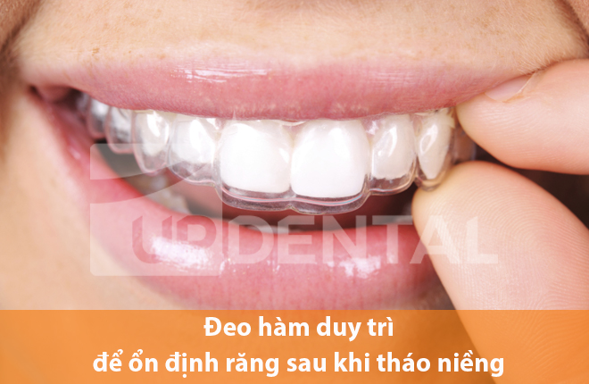 Đeo hàm duy trì niềng răng mắc cài kim loại