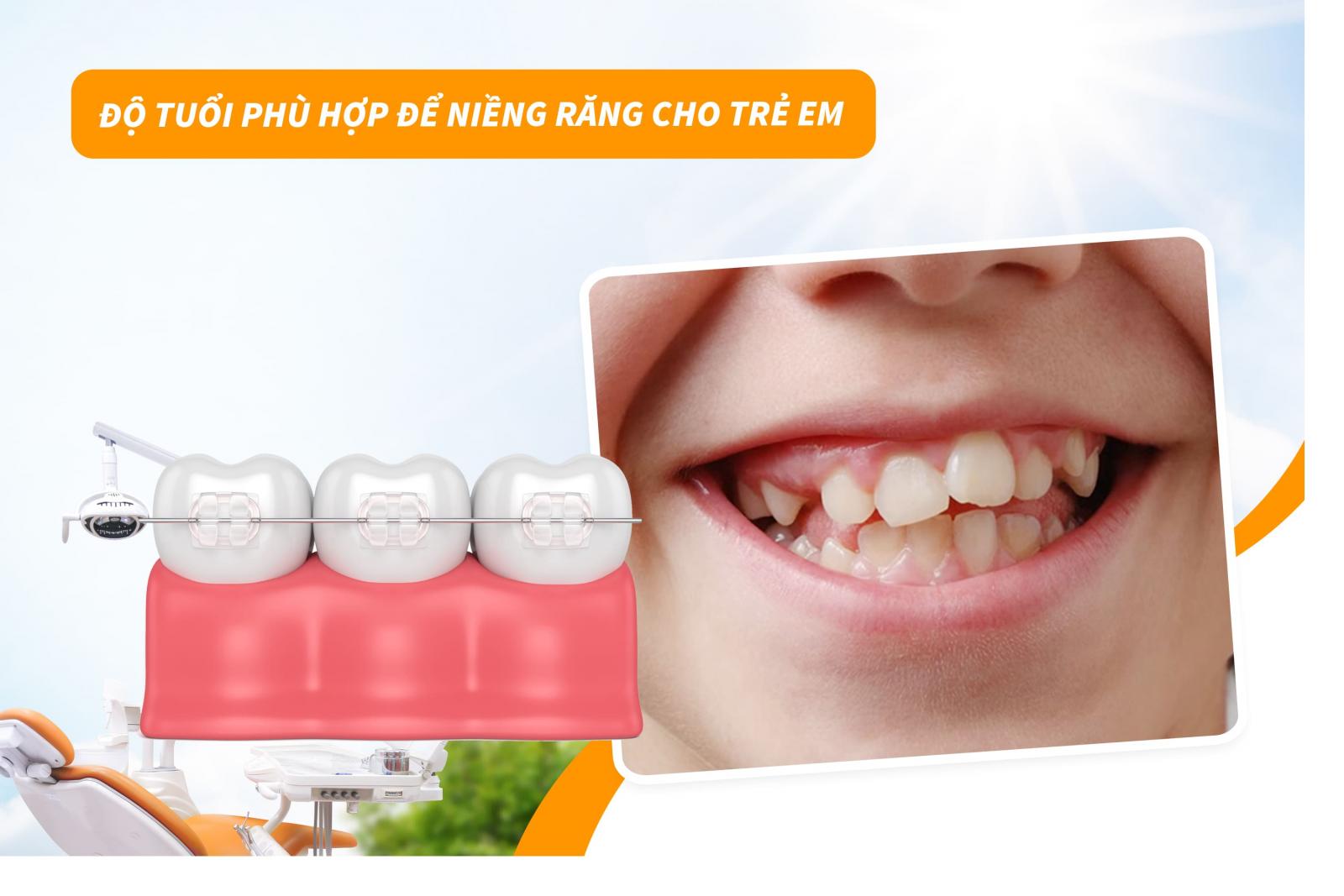 Độ tuổi phù hợp để niềng răng cho trẻ em