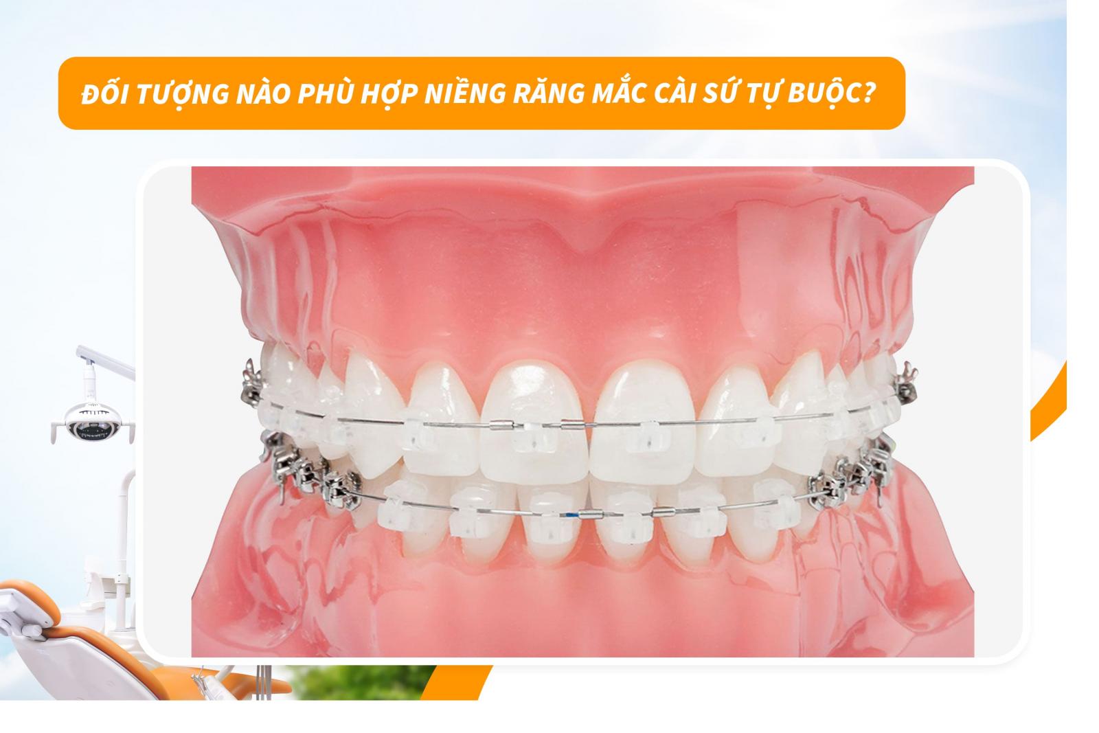 Đối tượng nào phù hợp niềng răng mắc cài sứ tự buộc?